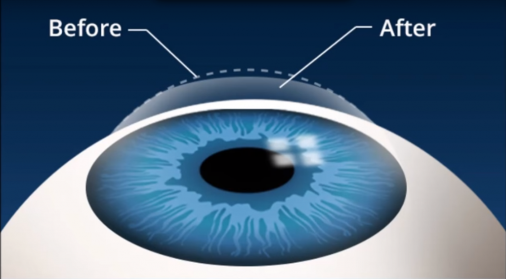 Laser Eye Surgery is LASEK
