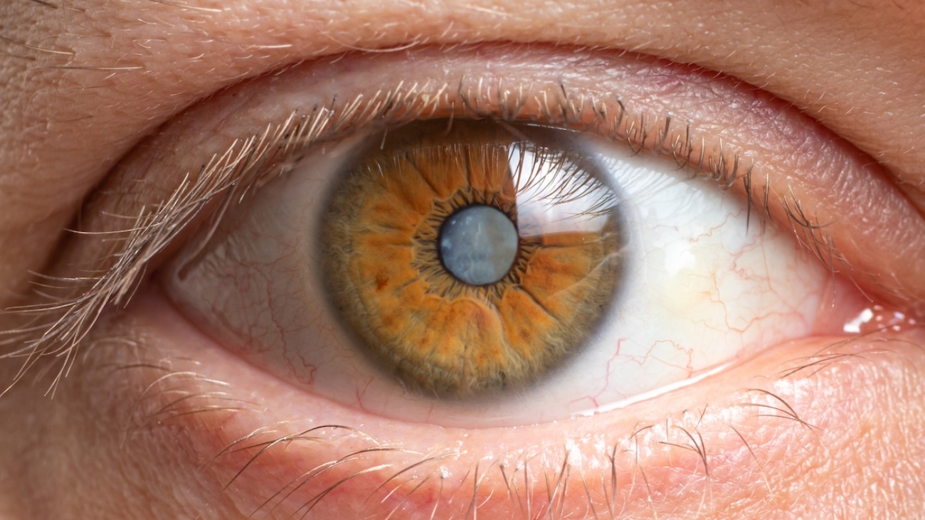 cataract cost